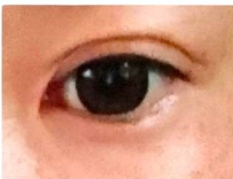 つまみを切って二重になったまぶた